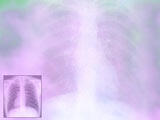 Chest X-Ray PowerPoint Templates